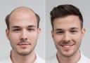 Мъжкото тупе: Дискретно решение за увереност и комфорт от Магама!