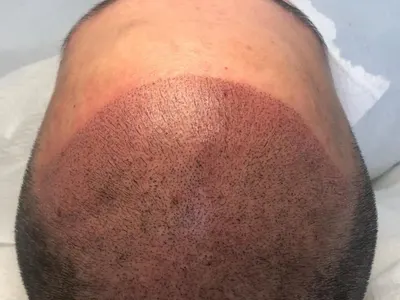 Микропигментация на скалпа в Магама – деликатно решение за плътна и красива коса