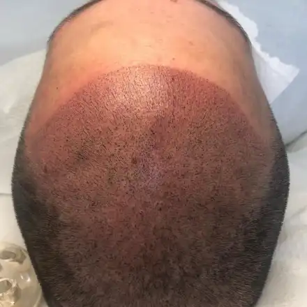 Микропигментация на скалпа в Магама – деликатно решение за плътна и красива коса