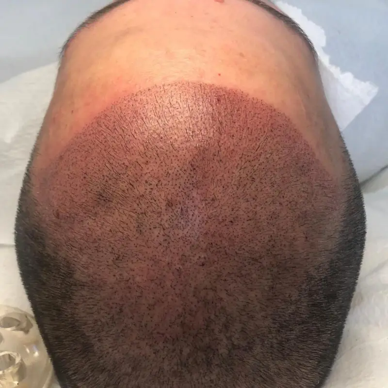 Микропигментация на скалпа в Магама – деликатно решение за плътна и красива коса