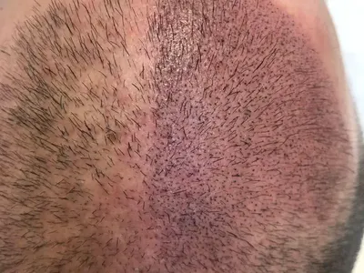 Микропигментация на скалпа в Магама – деликатно решение за плътна и красива коса