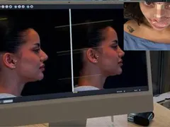 Скандал: Ергенката Валерия Дакова шокира с ринопластика!