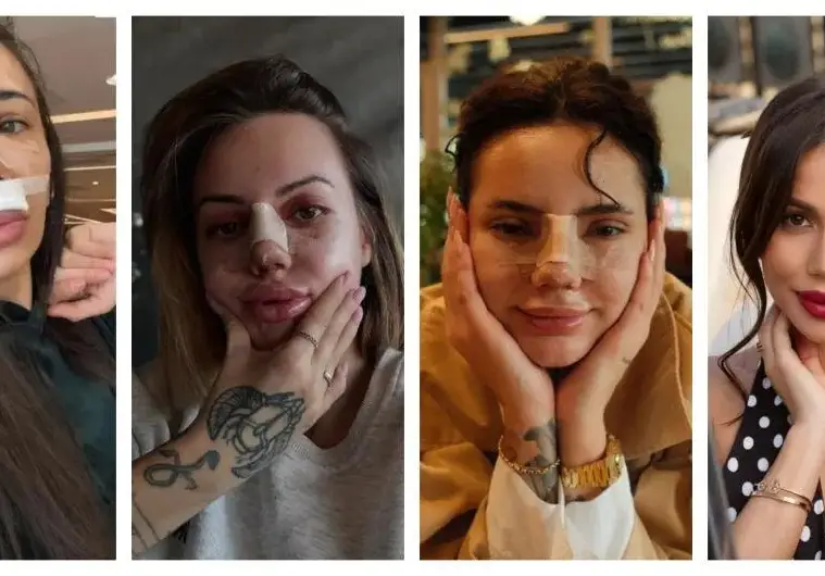 Масова истерия сред ергенките: Режат си носовете, но по-красиви ли са? (СНИМКИ)