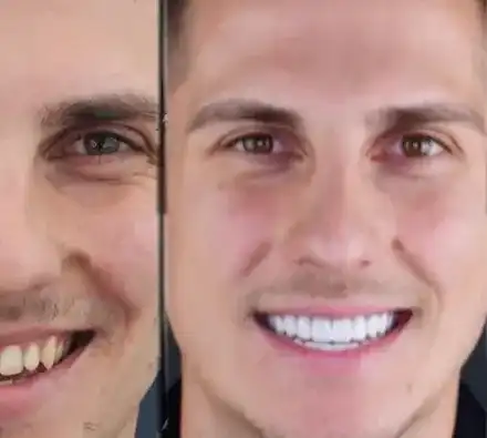 Петър от „Ергенът“ шокира с нова визия: фасети и ботокс!