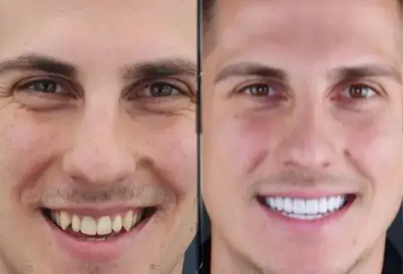 Петър от „Ергенът“ шокира с нова визия: фасети и ботокс!