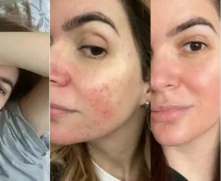 Розацеята на  Ива Софиянска се обостри