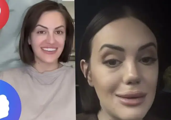 След новия си нос!! Анна-Мария Граченова каза: Харесвам се! (че какво друго да каже, като връщане няма - СНИМКИ)