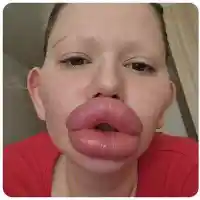 Шок! Българското Барби иска още хиалурон, докторите отказват!