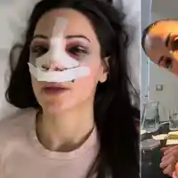 Лекар прецака носа на звезда от „Игри на волята“, прави я като Рамбо (ВИДЕО)