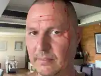 Шок! Гъмзата с ужасна злополука след разкрасителна процедура